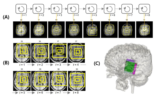 (A) 세브란스병원 ASD 환자의 MRI 빅데이터에서 인공지능 모델이 자폐 중증도와 관련된 뇌 주요 부위들의 연관 관계를 찾아내는 모습 (B) 국제컨소시엄으로 구축된 1000여 건의 자폐증 환자 MRI 빅데이터에서 인공지능 모델이 자폐 중증도와 관련된 뇌 주요 부위들의 연관 관계를 찾아내는 모습 (C) A와 B의 주요 부위를 3차원으로 표현한 뇌 이미지