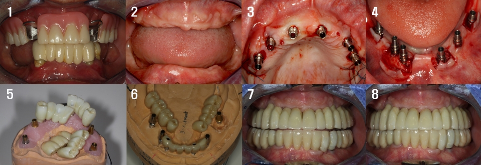 임플란트 고정성 크라운 보철치료. 제3의 치아로 리모델링이 완성되었다.