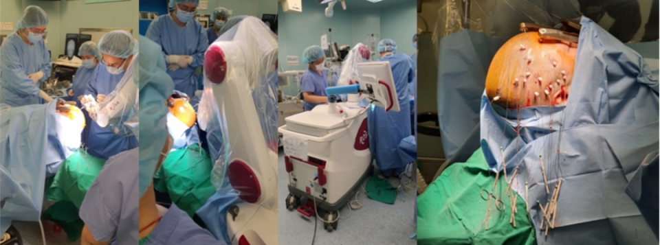 ROSA 뇌전증 로봇 수술 장면.수술장에서 ROSA 수술로봇을 이용하여 SEEG 심부전극을 삽입하는 과정과 14개 전극이 삽입된 모습 (오른쪽).