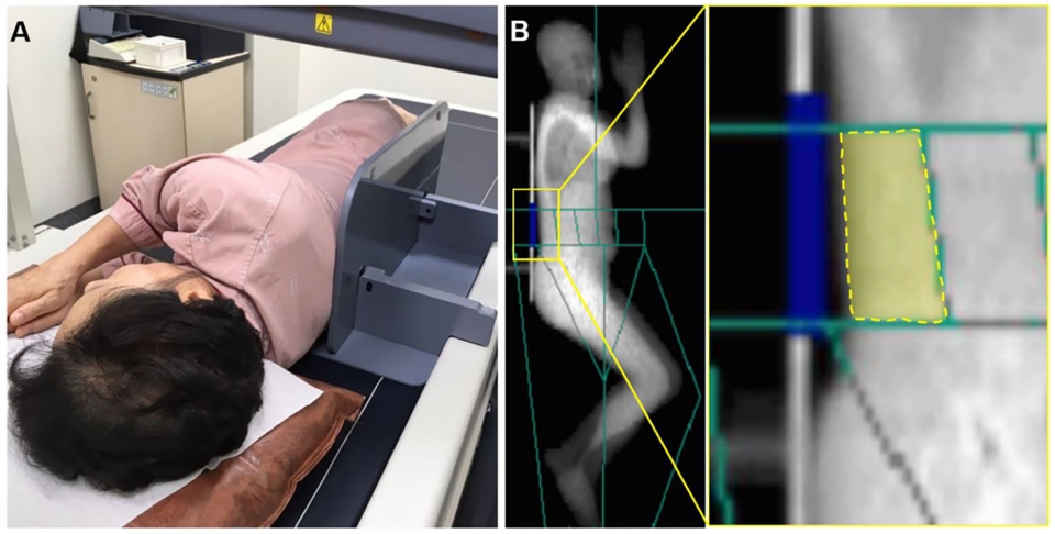골밀도 측정에 이용되는 이중에너지 방사선 흡수계측기(DEXA)로 척추근육 주위 근육의 체성분을 분석하는 장면.