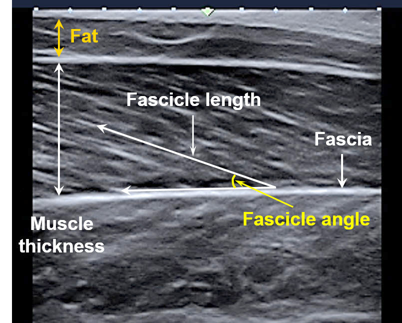 사이클 선수 근육을 초음파로 관찰한 사진이다. 근육은 하나의 덩어리가 아닌 다발형태로 되어있다. 초음파 이미지에서 여러 층으로 비스듬하게 보이는 구조가 근육다발(Muscle fascicle)이다.근육을 싸고 있는 근막(Fascia)이 지방과 다른 근육을 구분할 수 있게 하며, 이 근막에 근육다발이 붙게 된다. 근육다발이 근막에 대해 부착되어있는 각도를 근육다발의 각도(Fascicle angle)라고 한다.