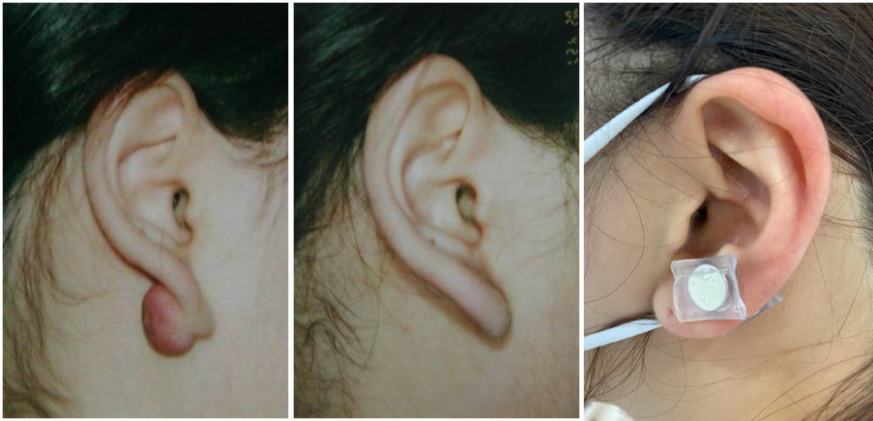 (左から) ケロイド術前，ケロイド術後，シリコン·ゲルシート磁石治療法適用の様子