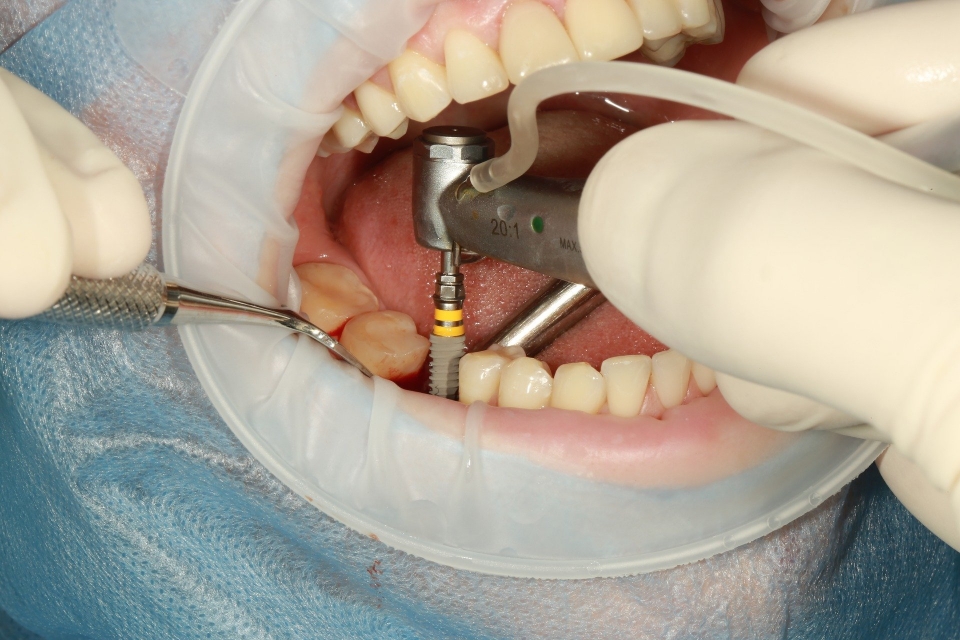 앞으로는 잇몸뼈(치조골)가 빈약하거나 없어서 임플란트 식립이 어려운 환자들의 고민이 사라질 것으로 보인다. 치조골을 쉽게 재생할 수 있는 기술이 국내 연구진에 의해 개발됐다.