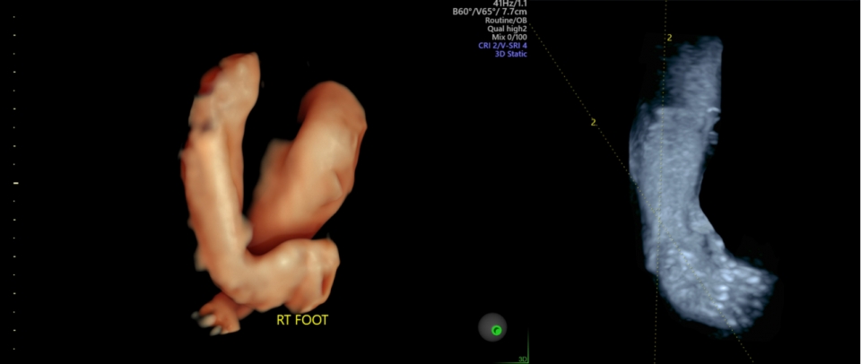 임신 30주에 촬영된 ‘선천성 만곡족’ 태아의 3차원 초음파 사진