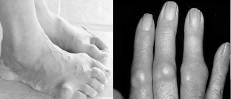 통풍성관절염에 의한 손과 발의 변형 모습