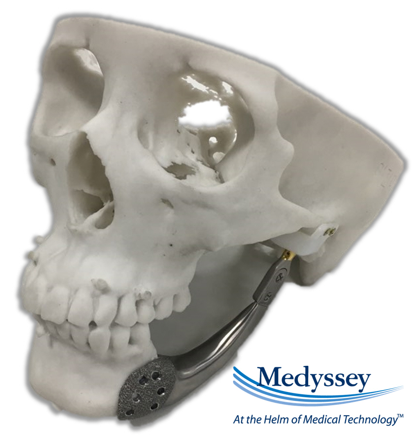 3D프린팅으로 제조된 환자맞춤형 인공 하악골 사진.