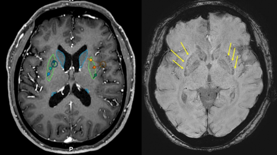 이식 전(왼쪽)후(오른쪽) MRI, 이식 후 MRI에서 성공적으로 세포가 이식된 부위를 확인할 수 있다(화살표) [사진=세브란스병원 제공]
