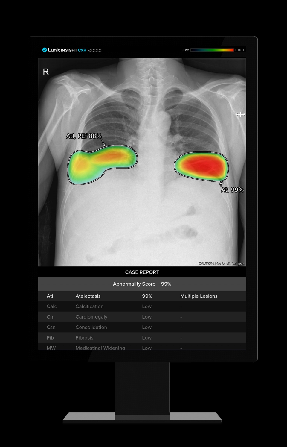 흉부 엑스레이 AI 영상분석 솔루션 ‘루닛 인사이트 CXR’
